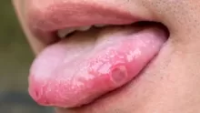 ما لا نعرفه عن أمراض اللسان وطرق علاجها