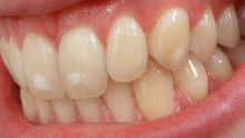 ما هي أضرار الفلورايد على الأسنان والعظام؟