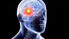 ما هي أعراض سرطان الدماغ وأسبابه وكيفية علاجه؟