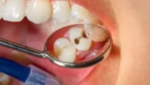 شكل سوسة الأسنان: علاجها والوقاية منها