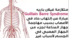 متلازمة غيلان باريه أعراضها وأسبابها وطرق علاجها
