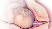 الطلق الصناعي فوائده وأضراره والحالات التي ينبغي تجنبه فيها