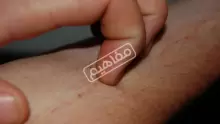 الأمراض النادرة في الدم وأعراضها وطرق علاجها