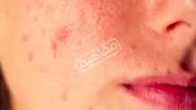 مرهم للحبوب المختلفة وحب الشباب والأنواع الجيدة منه