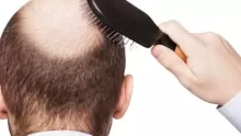 ما هي اسباب تساقط الشعر اثناء الكيتو دايت