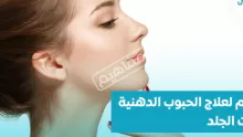 كريم لعلاج الحبوب الدهنية تحت الجلد ينصح به جميع الأطباء للتخلص من المشاكل