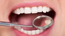 معلومات مهمة تبييض الاسنان بالليزر