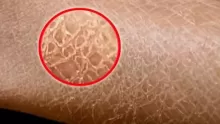 أبرز أسباب جفاف الجلد وأعراضه وطرق علاجه بطرق مجربة