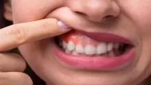 أهم أنواع التهاب اللثة وأسبابها وطرق العلاج