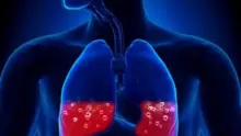 أعراض الانسداد الرئوي المزمن والوقاية منه وعلاجه