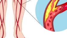 أسباب أمراض الأوعية الدموية وأعراضها وطرق معالجتها