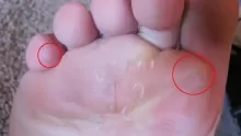 ما هو علاج فطر القدم الرياضي؟ وأهم أعراضه؟