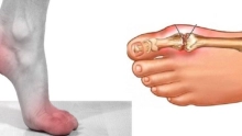 مرض النقرس أعراضه وعلاجه.. تعرف عليه