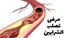 أبرز أسباب مرض تصلب الشرايين وأعراضه وطرق علاجه
