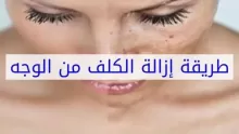القضاء على الكلف بطرق طبية وطبيعية