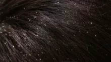 أسباب وطرق علاج قشرة الشعر 