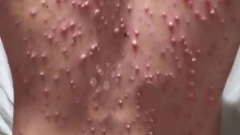 أسباب الحزام الناري وأعراضه وطرق علاجه