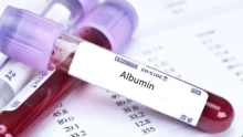 أسباب القيام بتحليل الألبومين Serum albumin test