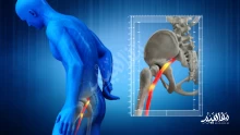 أعراض عرق النسا وطرق علاجه