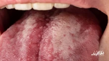 أهم أنواع وأعراض القلاع الفموي وطرق العلاج والوقاية منه