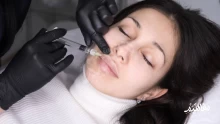 مميزات وفوائد فيلر الشفايف lips filler لتجميل المرأة