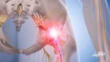 اعراض التهاب العصب الوركي اسبابه وعلاجه