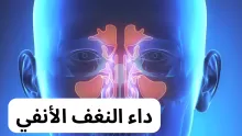داء النغف الأنفي | الأسباب - الأعراض - طرق العلاج والوقاية