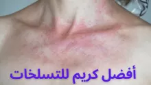 أفضل كريم تسلخات لعلاج التهاب البشرة في الصيدليات