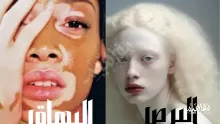 الفرق بين البرص والبهاق