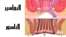 الفرق بين الناسور والبواسير