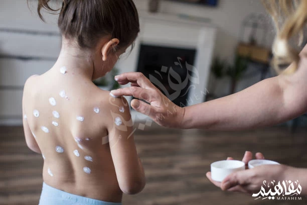 الجدري المائي الجدري المائي