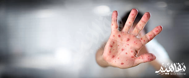 الجدري المائي الجدري المائي