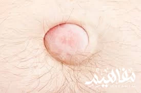 الفتق الفتق