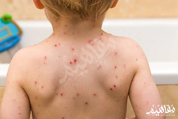 الجدري المائي الجدري المائي