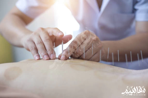 الإبر الصينية