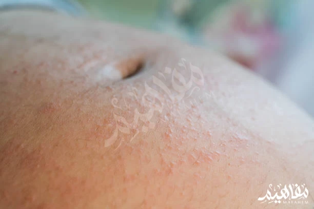 Skin problems during pregnancy Skin problems during pregnancy