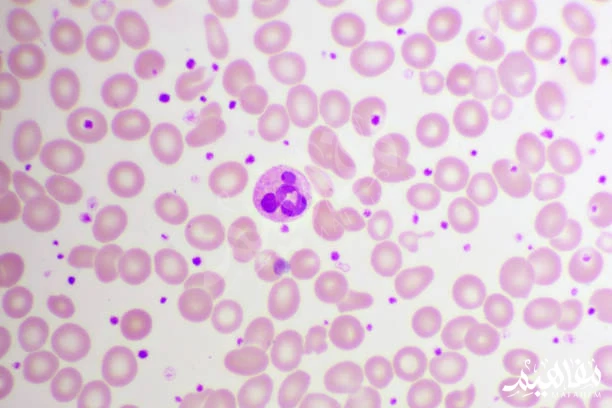 thrombocytopenia thrombocytopenia