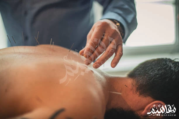 الإبر الصينية