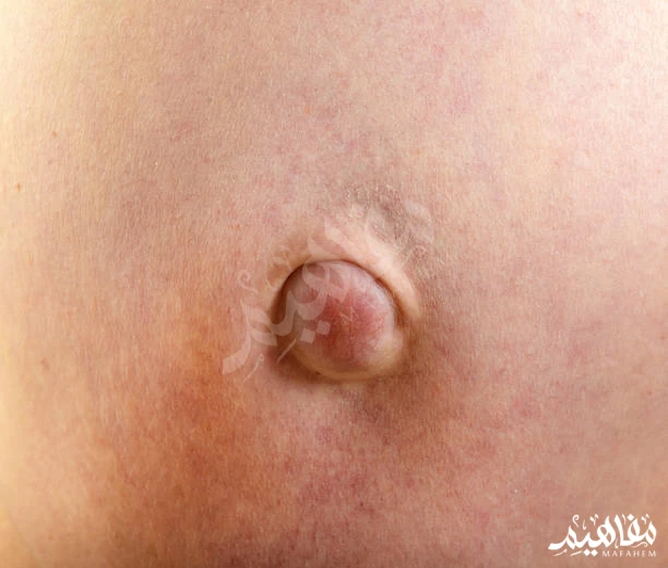 Umbilical hernia Umbilical hernia