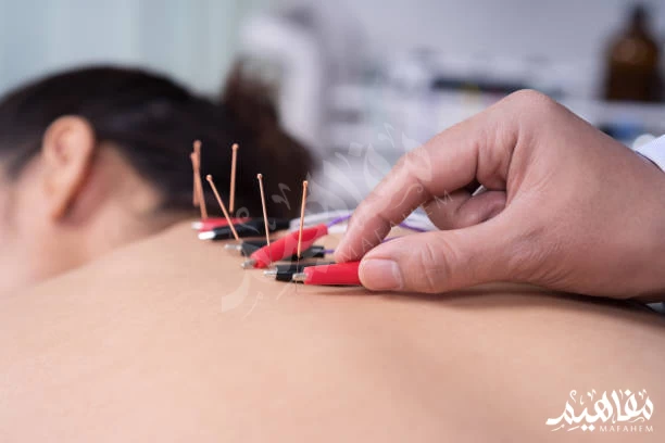 الإبر الصينية