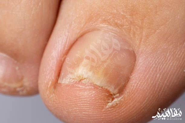 nail fungus nail fungus