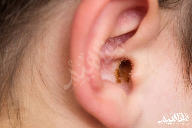 Earwax Earwax