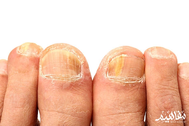 nail fungus nail fungus