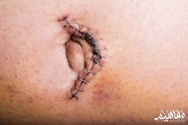 Umbilical hernia Umbilical hernia