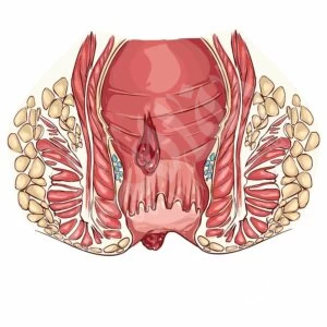 شكل البواسير الداخلية شكل البواسير الداخلية