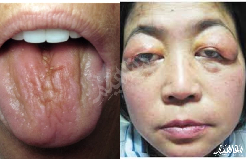 Sjögren's syndrome Sjögren's syndrome