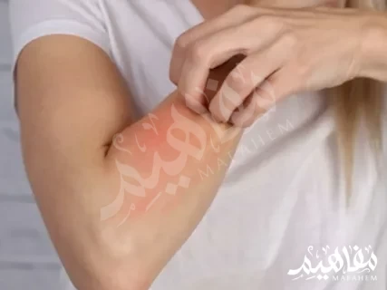 ديرموفيت لحساسية