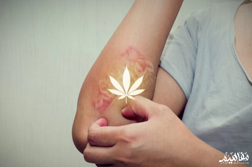 ديرموفت والاكزيما