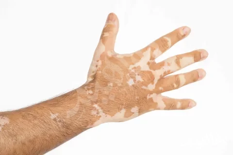 ديمفيت والبهاق