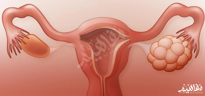 تكيس المبايض تكيس المبايض